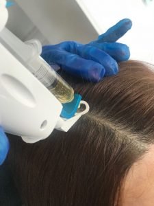 Meso-Hair-Treatment